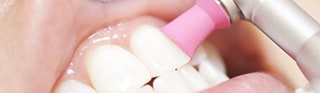 歯石除去やPMTC等の予防に特化